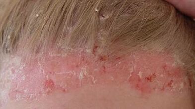 Entwicklungsstadien und Symptome der Psoriasis