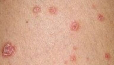 Foto von Psoriasis im Frühstadium