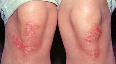 Haupterscheinungen der Psoriasis