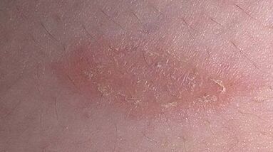 wie und womit man Psoriasis behandelt