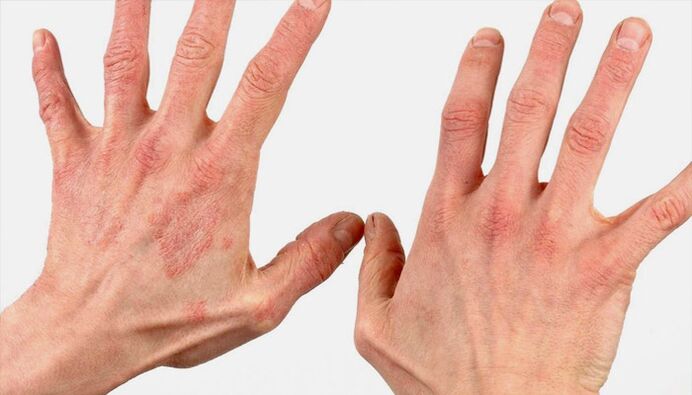 Methoden zur Behandlung von Psoriasis mit Volksheilmitteln