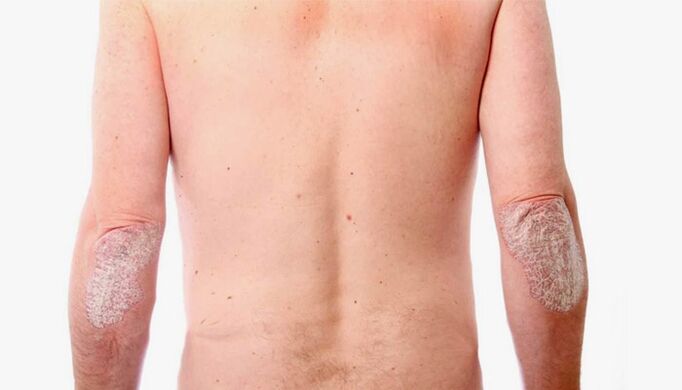 Volksheilmittel zur Behandlung von Psoriasis