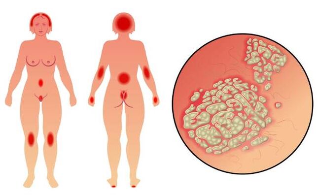 Symptome der Psoriasis