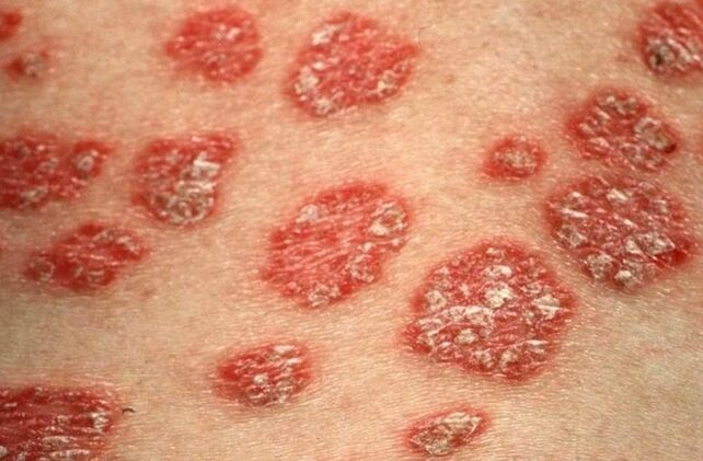 Psorial Papule