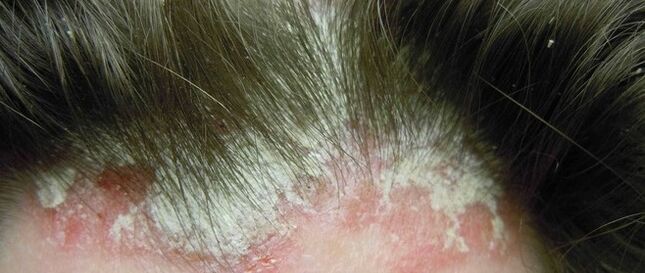 Psoriasis am Kopf