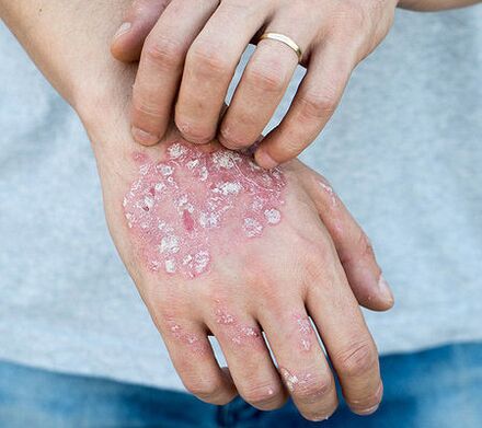Psoriasis am Arm