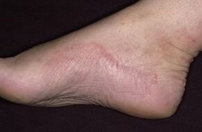 Fußpsoriasis