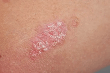 Psoriasis - Anfangsstadium