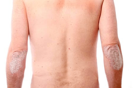 Allgemeine Symptome von Psoriasis