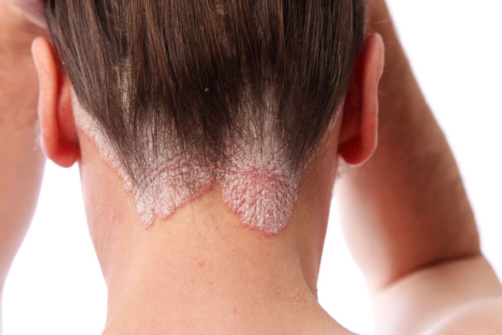 Behandlung von Psoriasis