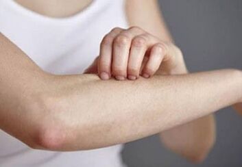 Psoriasis an der Hand