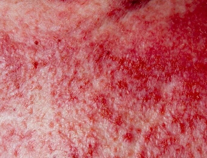 Fortgeschrittene Form der Psoriasis