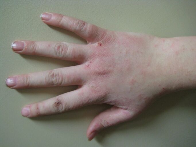 Psoriasis im Frühstadium