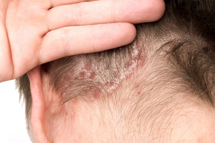 Verschlimmerung der Psoriasis am Kopf