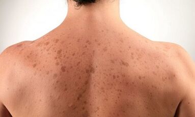 Gründe für die Entstehung einer Psoriasis