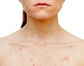 An welchen Körperstellen tritt Psoriasis auf
