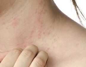 Hauptsymptome der Psoriasis