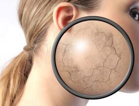 Wie sich Psoriasis äußert