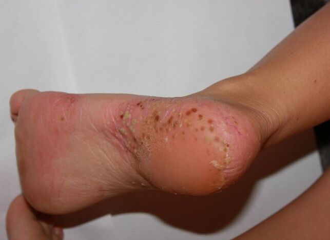 Palmoplantare Psoriasis