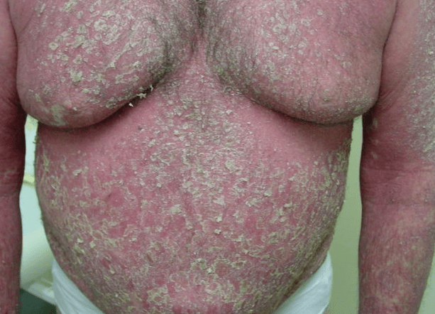 Psoriasis-Erythrodermie am Körper