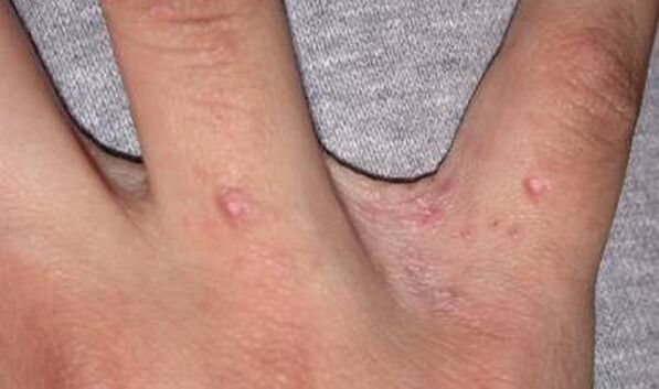 Der Beginn der Psoriasis