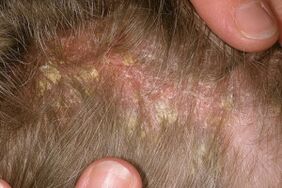 Psoriasis am Kopf