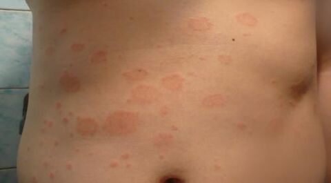 Psoriasis am Körper