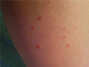 Psoriasis auf der Haut